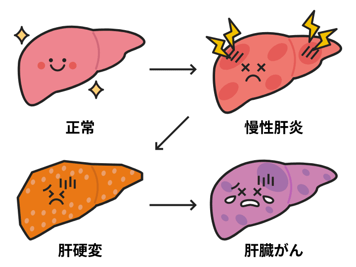 正常、慢性肝炎、肝硬変、肝臓がん それぞれの説明イラスト